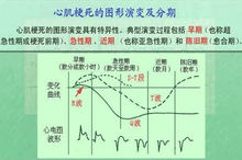 心肌梗死的图形演变及分期