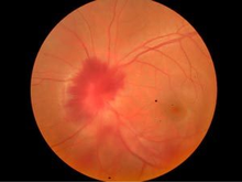 变应性肉芽肿血管炎