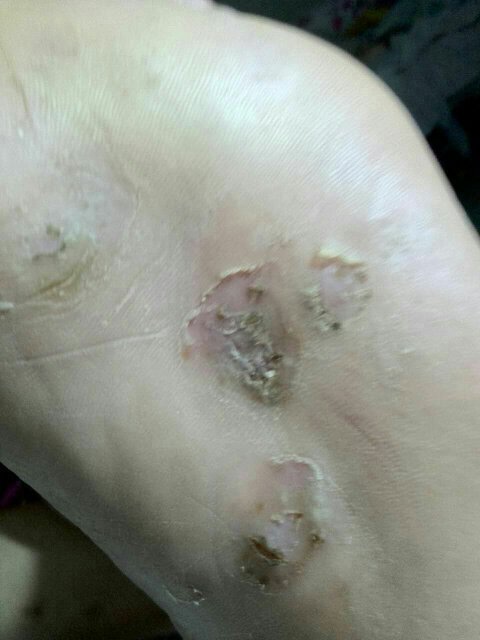 爸爸一直有脚气这次比较严重脚底都烂了裂开了