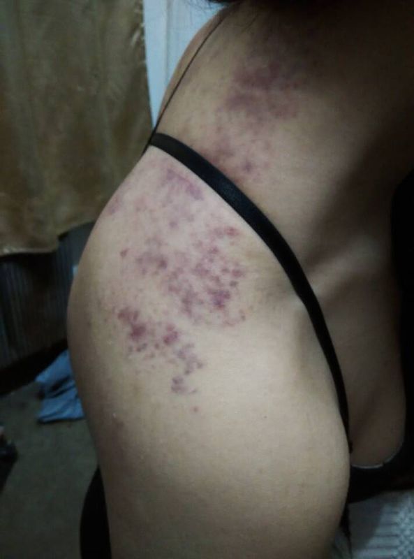 刮痧后背部颜色判断_360问答