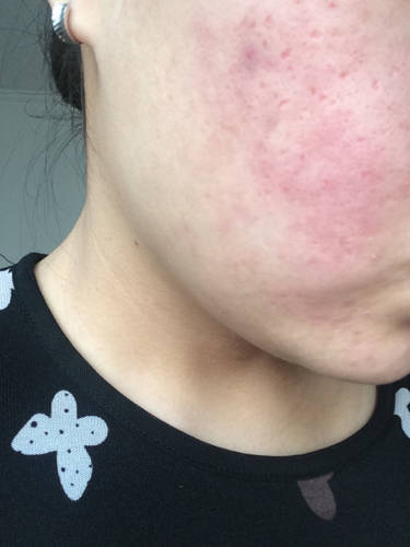 精油浓度过高把脸灼伤了有什么办法快速恢复吗_360问答