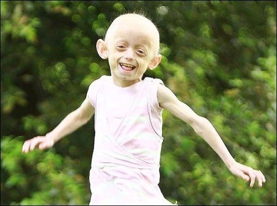 早老症(progeria)又称hutchinson–gilford综合征,是一种早